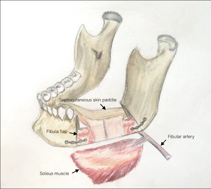 FREE FLAP RECONSTRUCTION