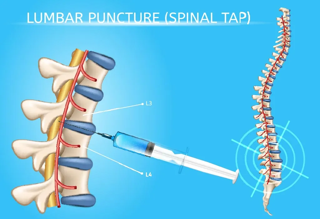 Lumbar puncture Image