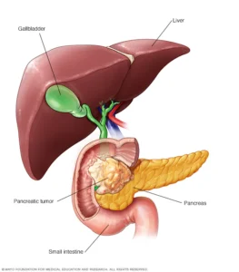 PANCREATIC CANCER