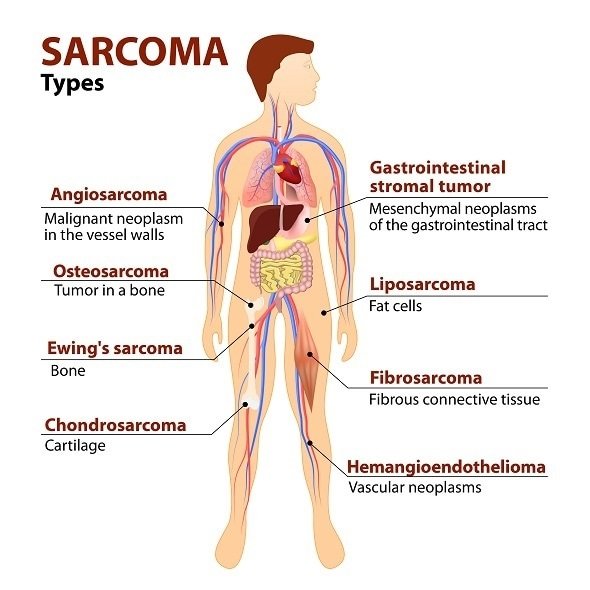 SARCOMAS