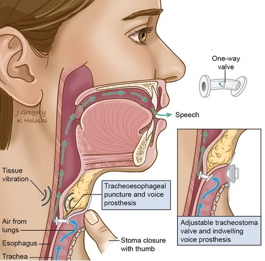 TRACHEO ESOPHAGEUL PUNCTURE